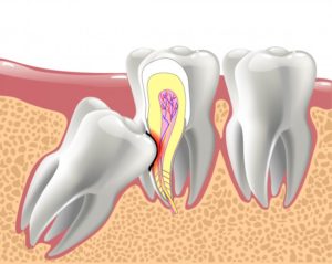 an illustration of an impacted wisdom tooth