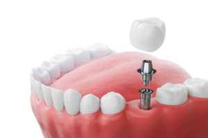 a computer illustration showing the different parts of a dental implant